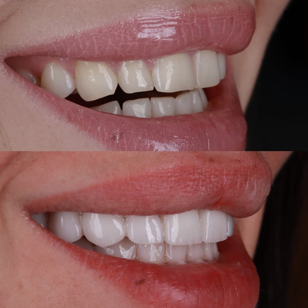 Cosmetic smile simulation and digital shade matching