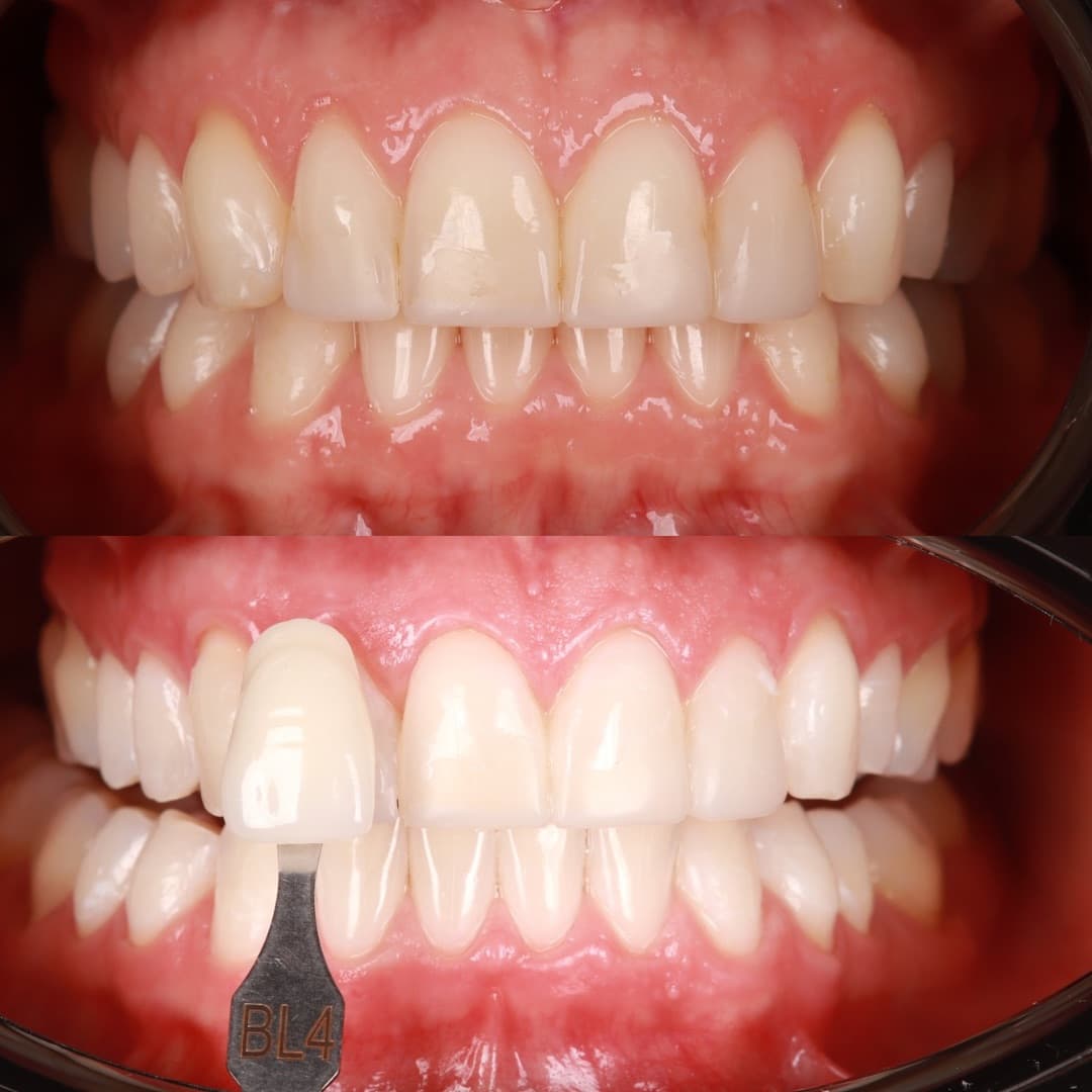 Digital smile scanning equipment and clinical materials